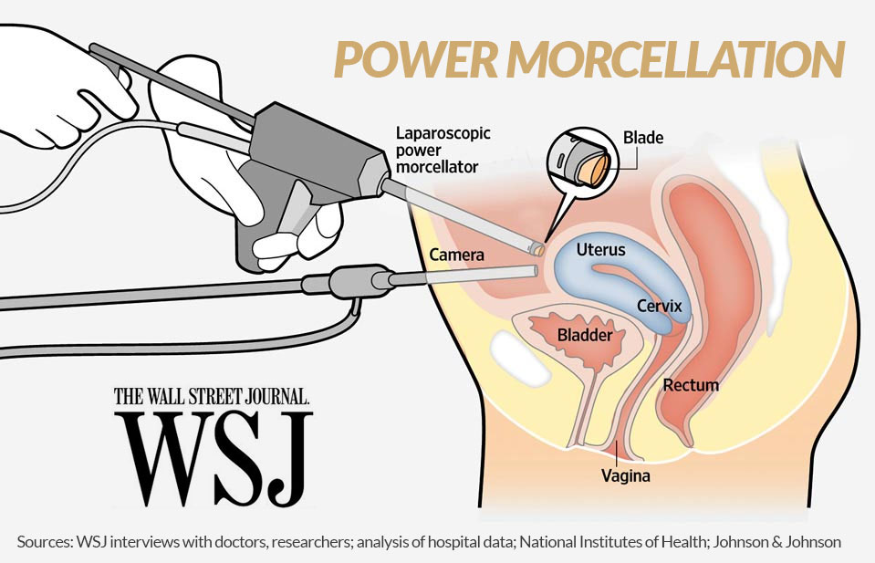 power-morcellation-example